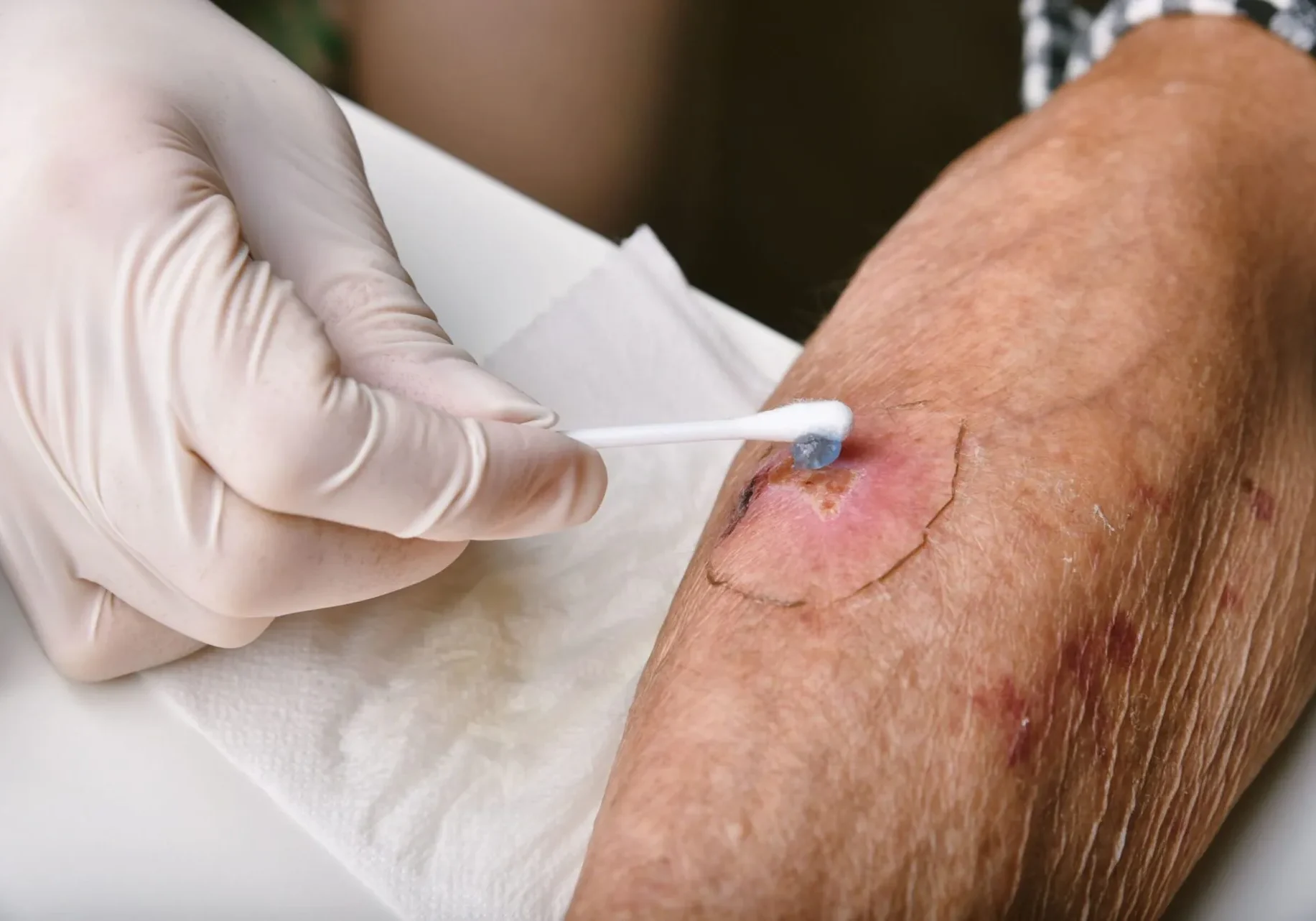 at-home-wound-care-scaled